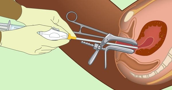 Abortion